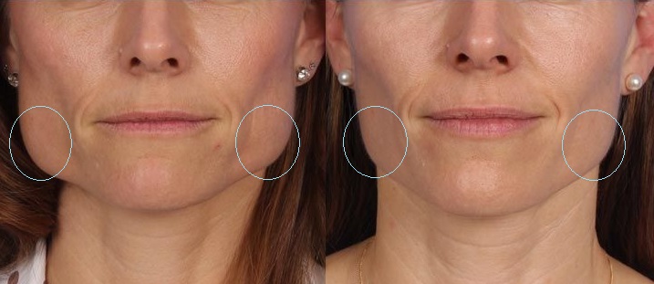 Jawline Botox - Reneu Health & MediSpa